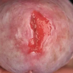 Guzek na prąciu erytroplazja Queyrata