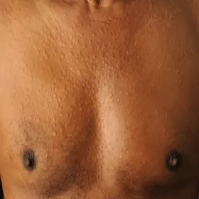 Guzki grudki na klatce piersiowej ziarniniak obrączkowaty 