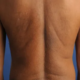 Guzki grudki na plecach ziarniniak obrączkowaty 