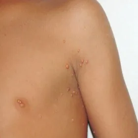 Guzki na ciele dziecka żółtakoziarniniakowatość młodzieńcza 