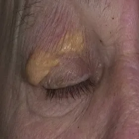 Guzki na powiece oka żółtaki 