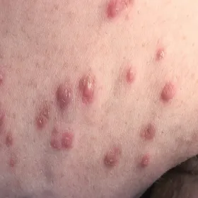 Guzki na skórze choroba Kyrle