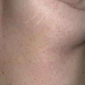 Guzki na skórze pod piersiami syringoma