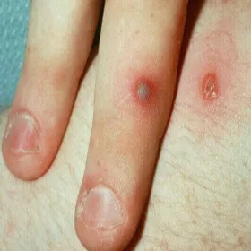 Guzki na skórze rzeżączka 