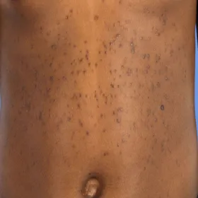 Guzki na skórze syringoma