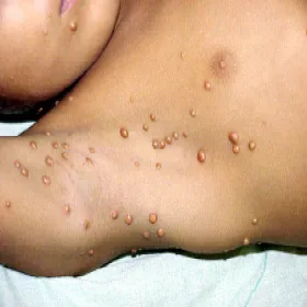 Guzki na stopach żółtakoziarniniakowatość młodzieńcza 