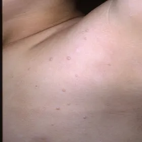 Guzki pod pachą u dziecka 