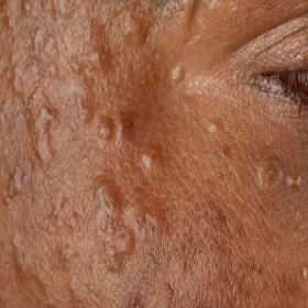 Guzki skórne syringoma