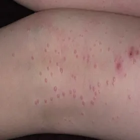 Guzki w mięczaku zakaźnym na skórze