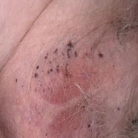 Guzki w okolicach intymnych kobiet rogowiec krwawy