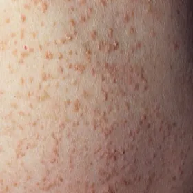 Guzki wielkości prosa na skórze choroba Kyrle