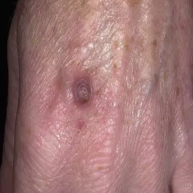 Guzy na rękach zdjęcia