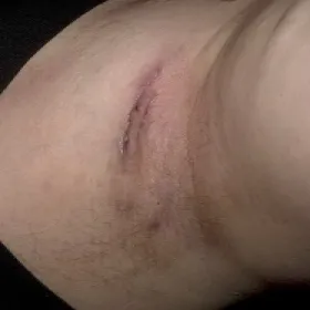 Hidradenitis suppurativa HS