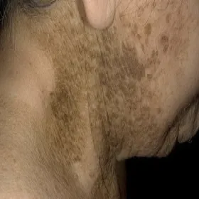 Hiperkeratoza na szyi