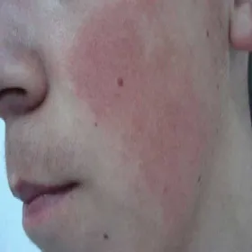 Hiperkeratoza skóry twarzy