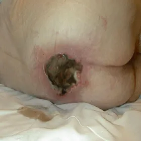 IV stopień odleżyn zdjęcie