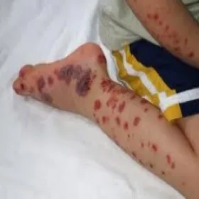 Idiopatyczna plamica małopłytkowa u dzieci