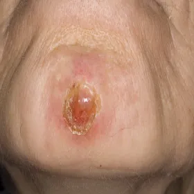 Infekcja bakteryjna liszajec zakaźny