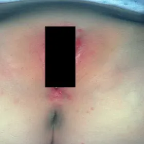 Infekcje okolic intymnych u kobiet mięczak zakaźny