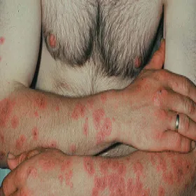 Inny rumień wielopostaciowy