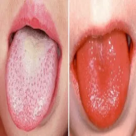 Język w czasie choroby szkarlatyny