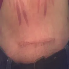 Jak wygląda blizna keloidowa po cesarskim cięciu