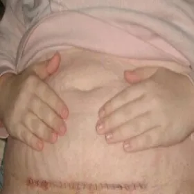 Jak wygląda bliznowiec po cesarce