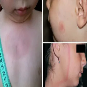 Jak wygląda borelioza rumień u dzieci