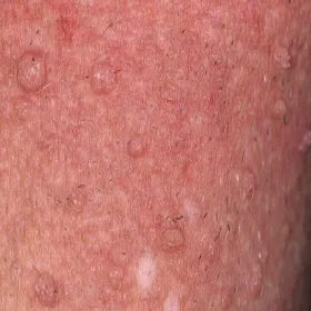 Jak wygląda brodawka