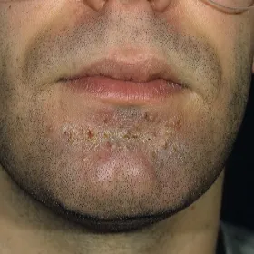 Jak wygląda figówka gronkowcowa 