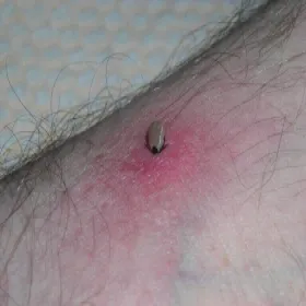 Jak wygląda kleszcz w skórze