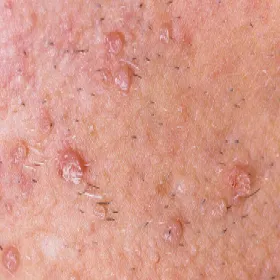 Jak wygląda kurzajka