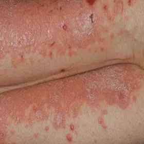 Jak wygląda liszaj czerwony zdjęcia