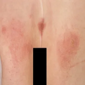 Jak wygląda odleżyna 