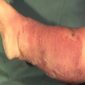 Jak wygląda róża choroba