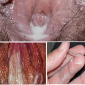 Jak wygląda rzeżączka