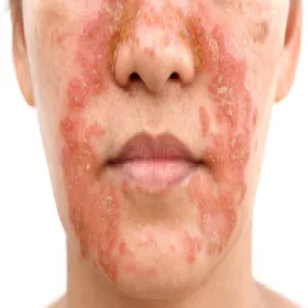 Jak wygląda wyprysk łojotokowy 