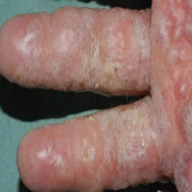 Jak wygląda wyprysk dyshydrotyczny