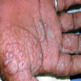 Jak wygląda wyprysk pęcherzykowy