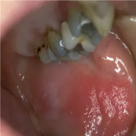 Jama ustna choroby zespół Brandta