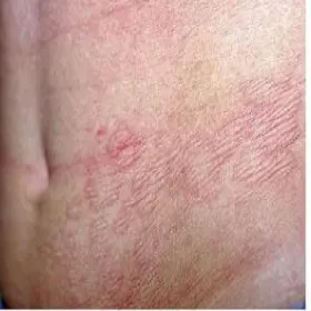 Jasnoróżowe plamy na skórze - zanik plamisty skóry