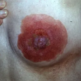 Kłucie i swędzenie sutka