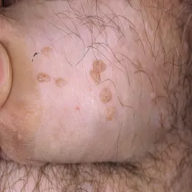 Kłykciny kończyste u mężczyzny