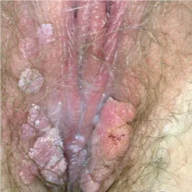 Kłykciny kończyste u kobiet