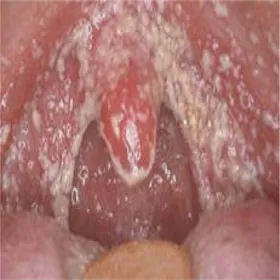 Kandydoza rzekomobłoniasta ostra 