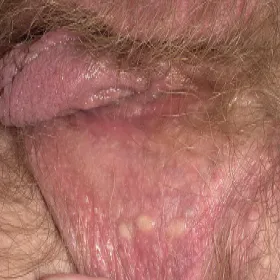 Kaszak na wardze sromowej