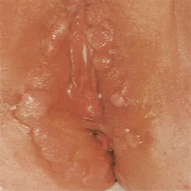 Kiła wysypka miejsca intymne kobiet