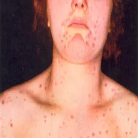 Kiła wysypka u kobiet 