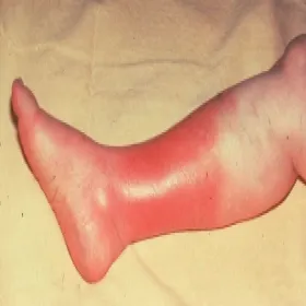 Klasyczna objaw róży choroby