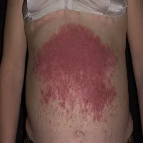 Krostki na brzuchu choroba Dariera